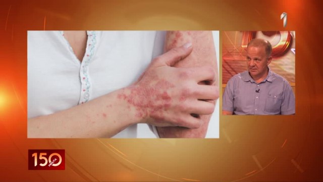 Dr Majcan o psorijazi: "Sve bolesti su izleèive, ali nisu svi pacijenti" VIDEO